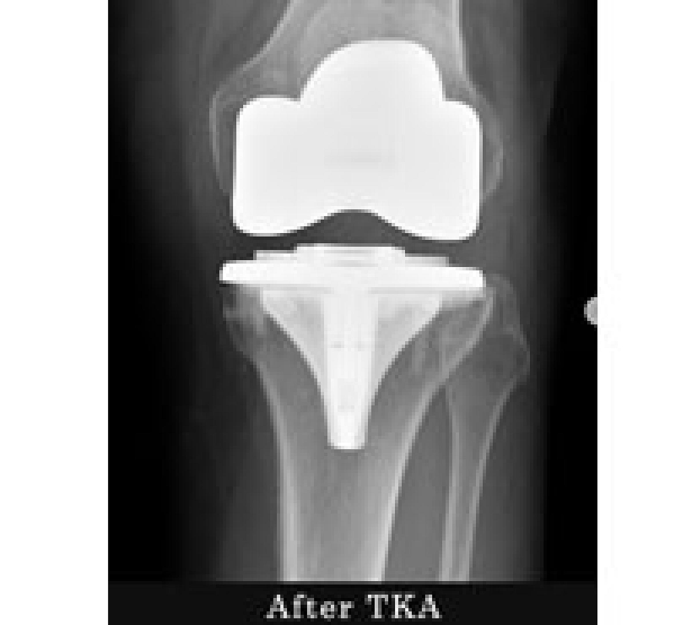 X-ray of knee bones after total knee replacement