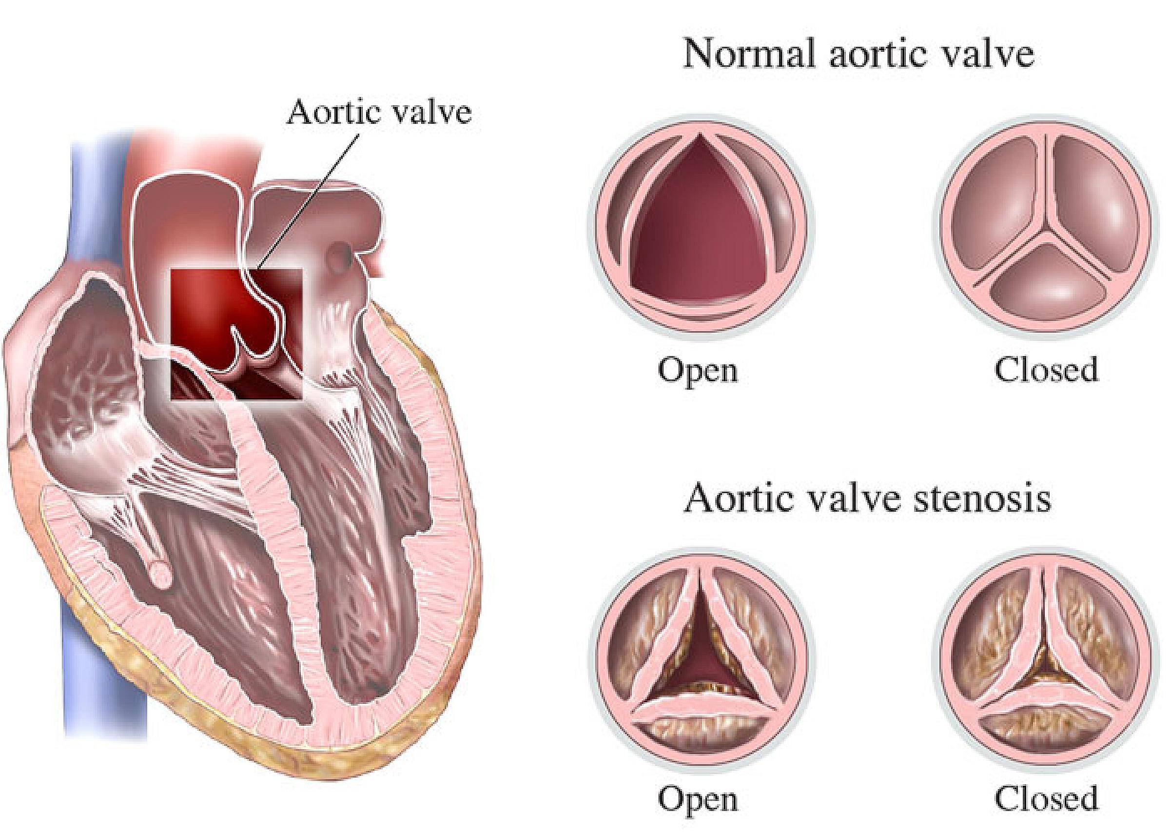 Aortic valve illustration and aortic valve stenosis