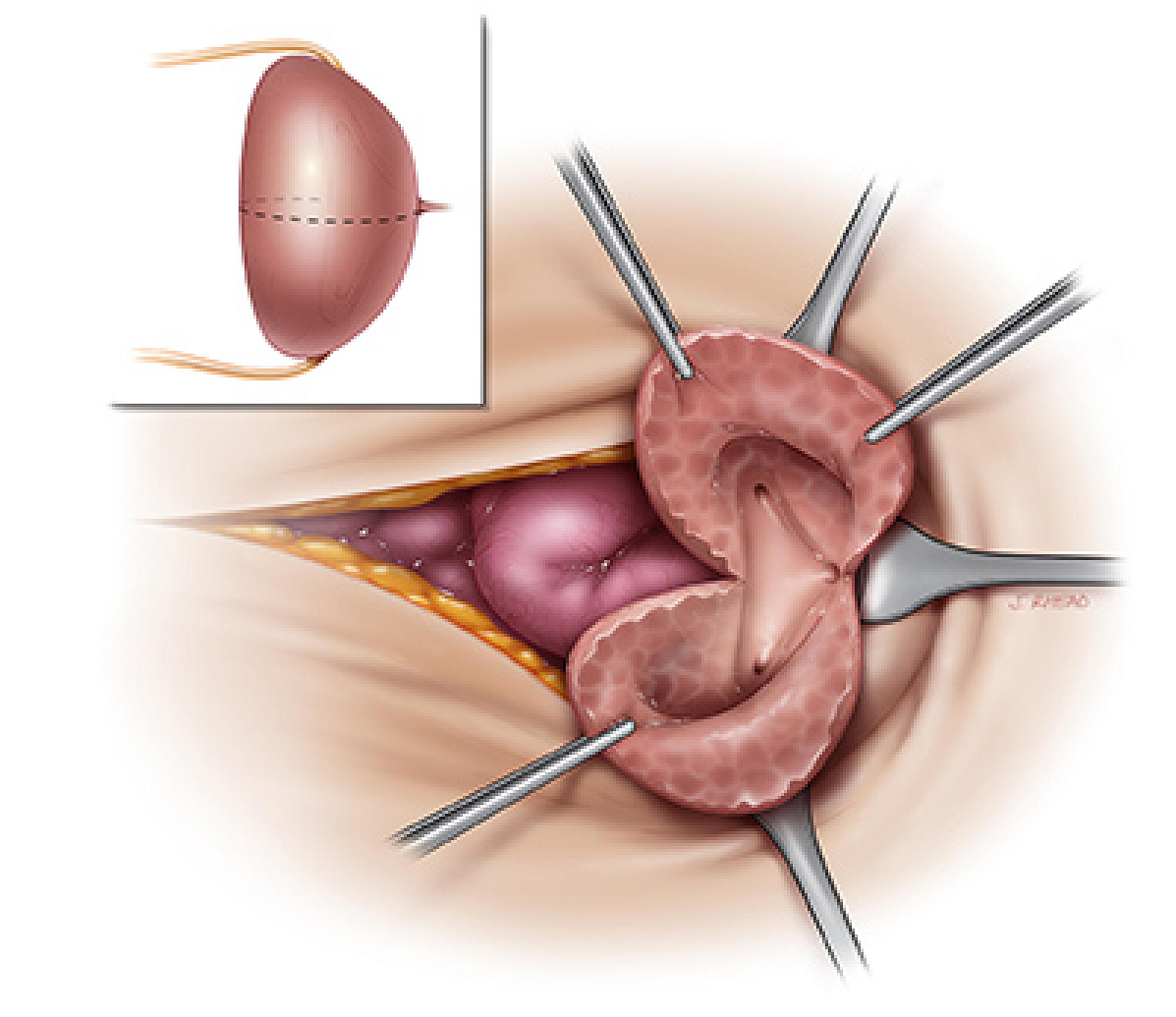 An illustration of the incision for the procedure
