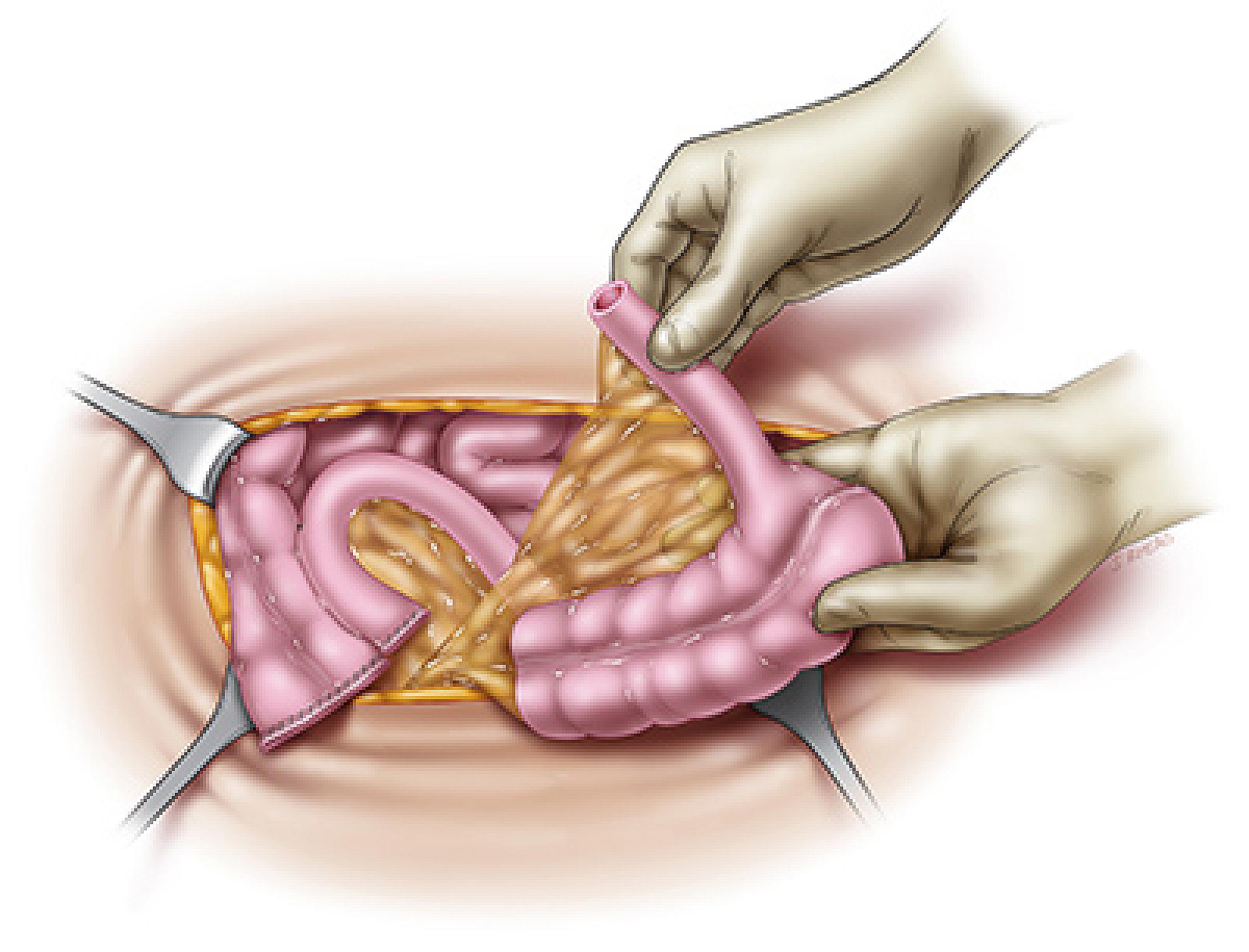 An illustration of the incision for the procedure