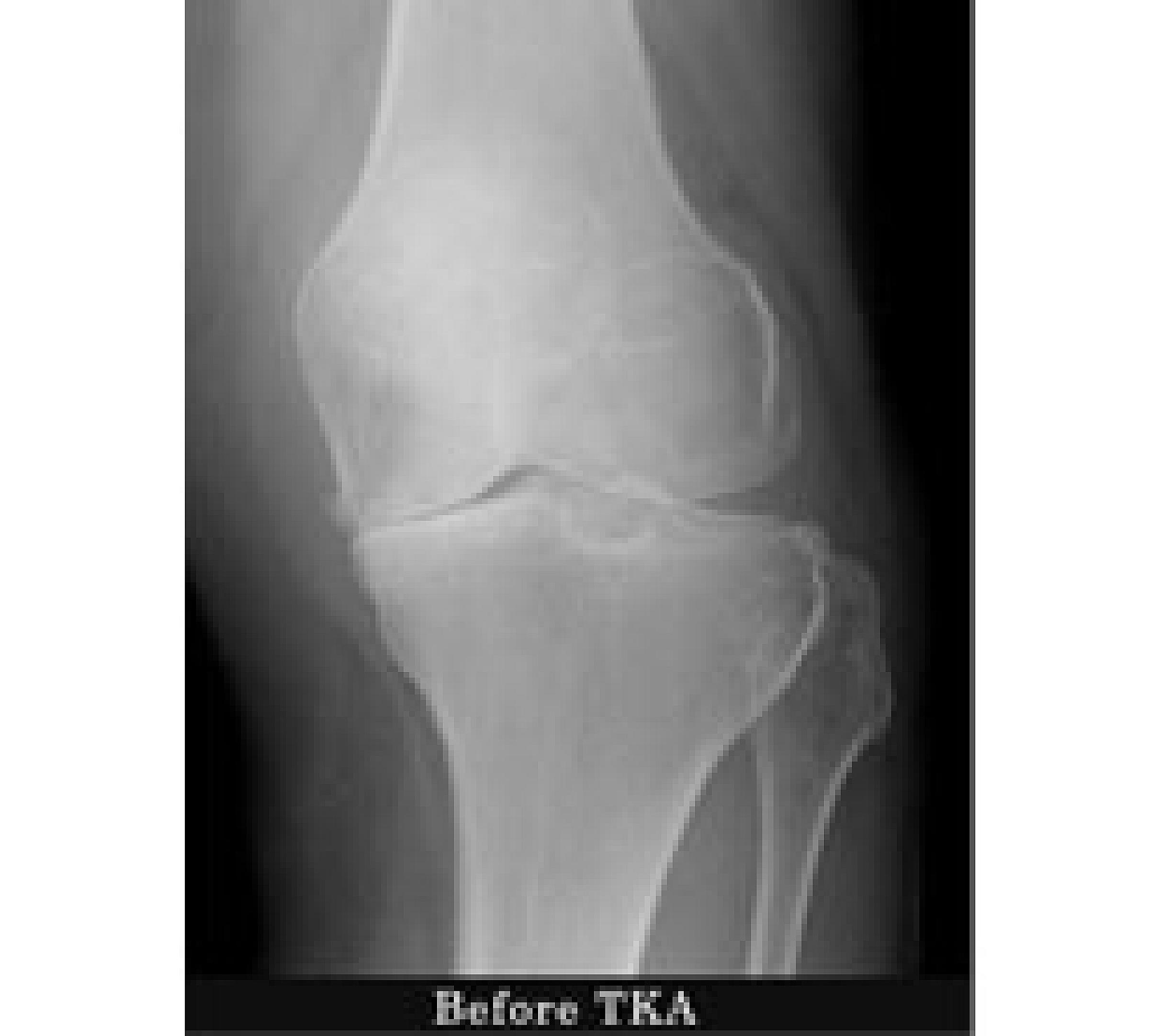 X-ray of knee bones before total knee replacement surgery