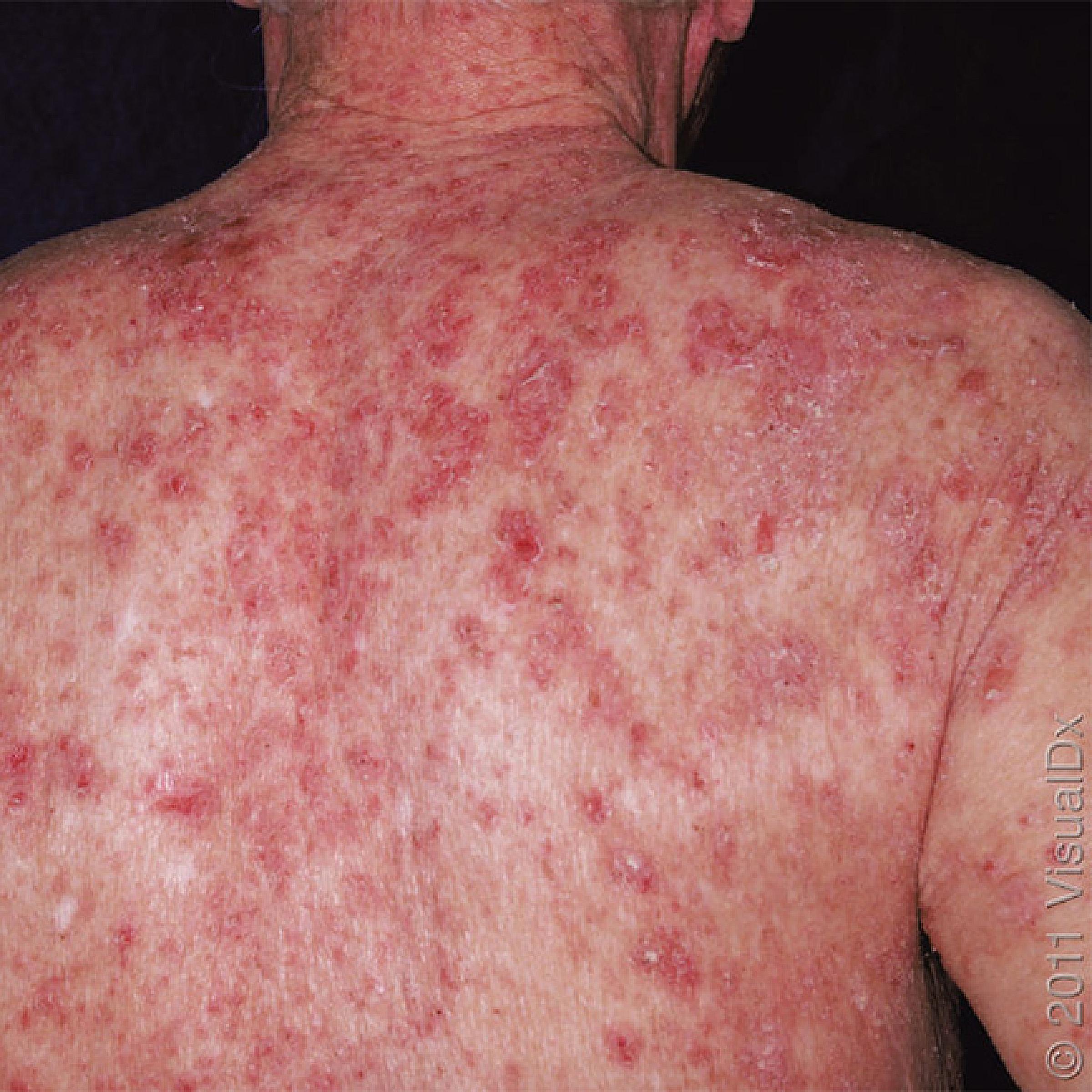 A person's back with pemphigus blisters