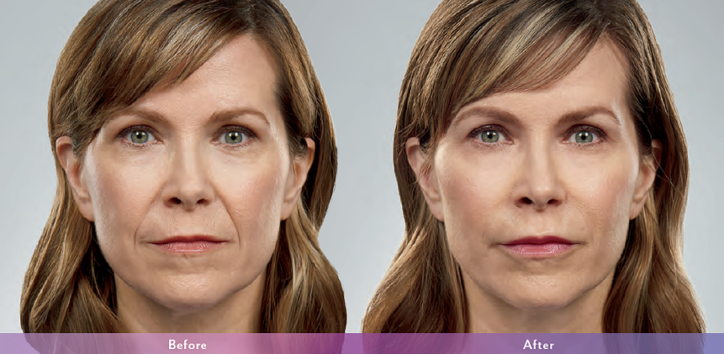 Before and after results from liquid facelifts