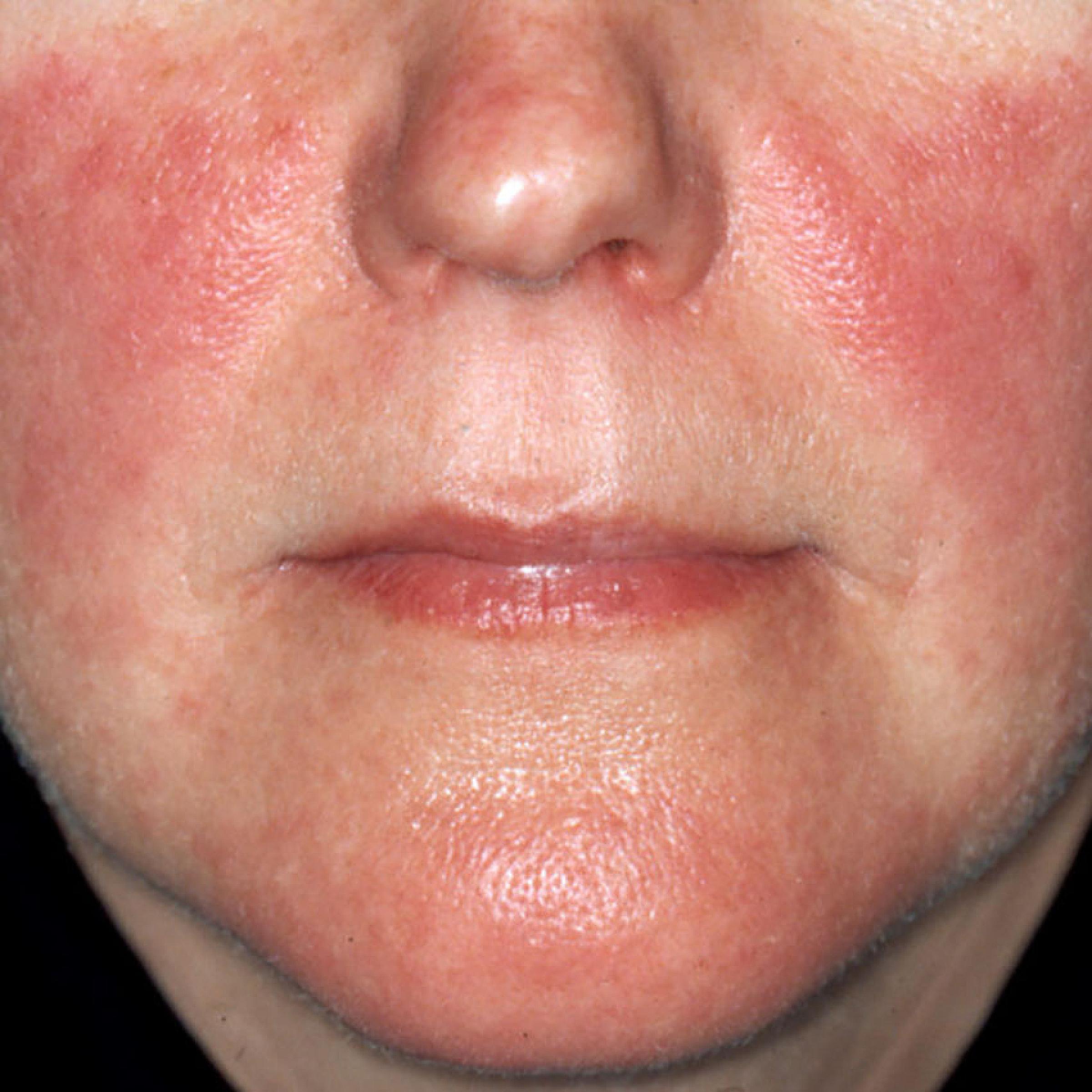 Lupus face rash