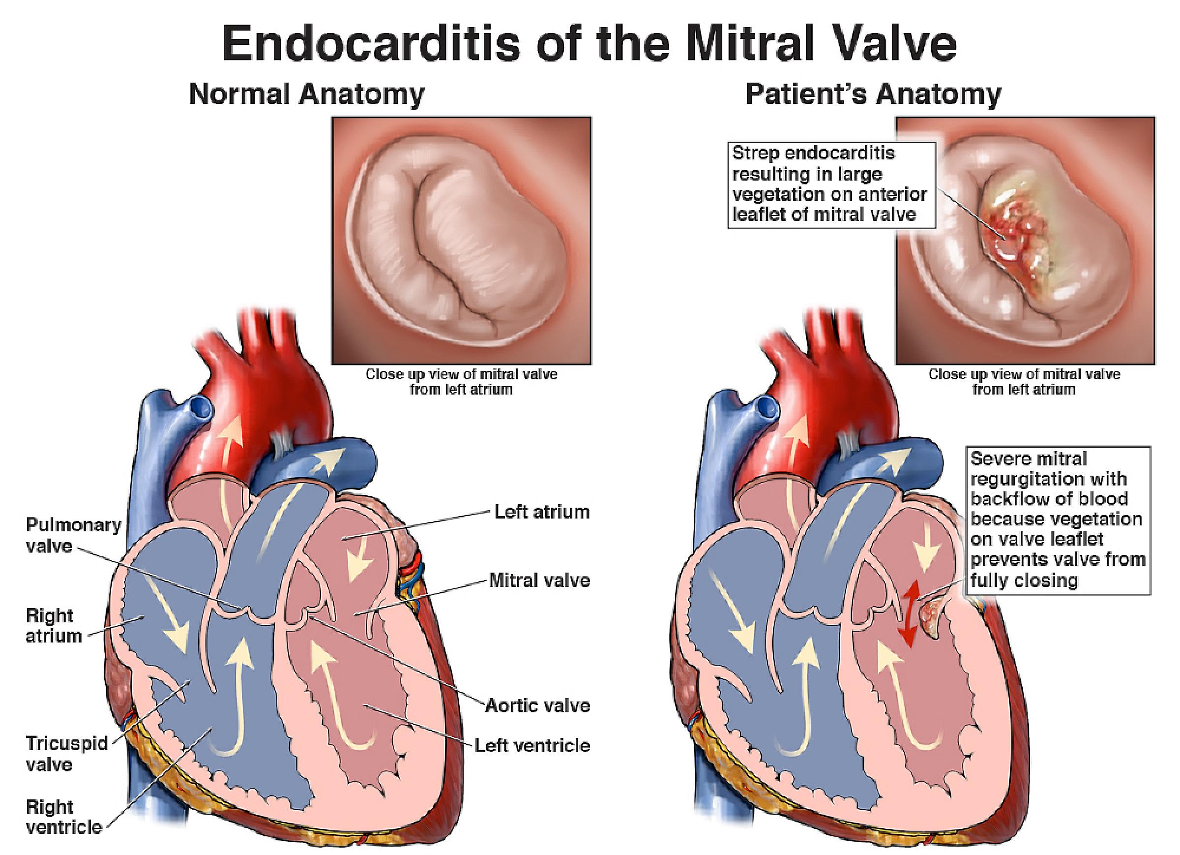 Image of endocarditis of the mitral valve