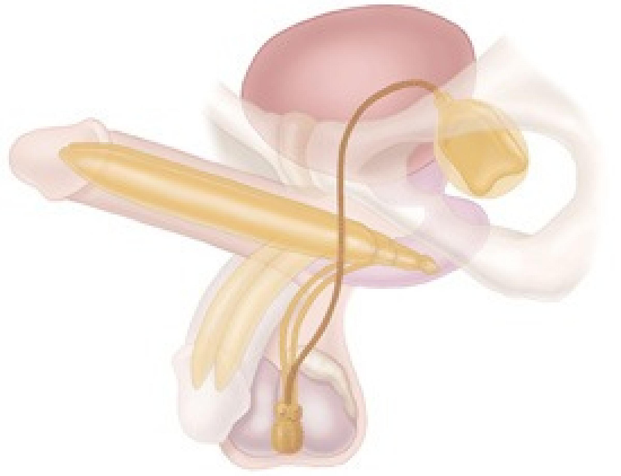 diagram of a penile implant