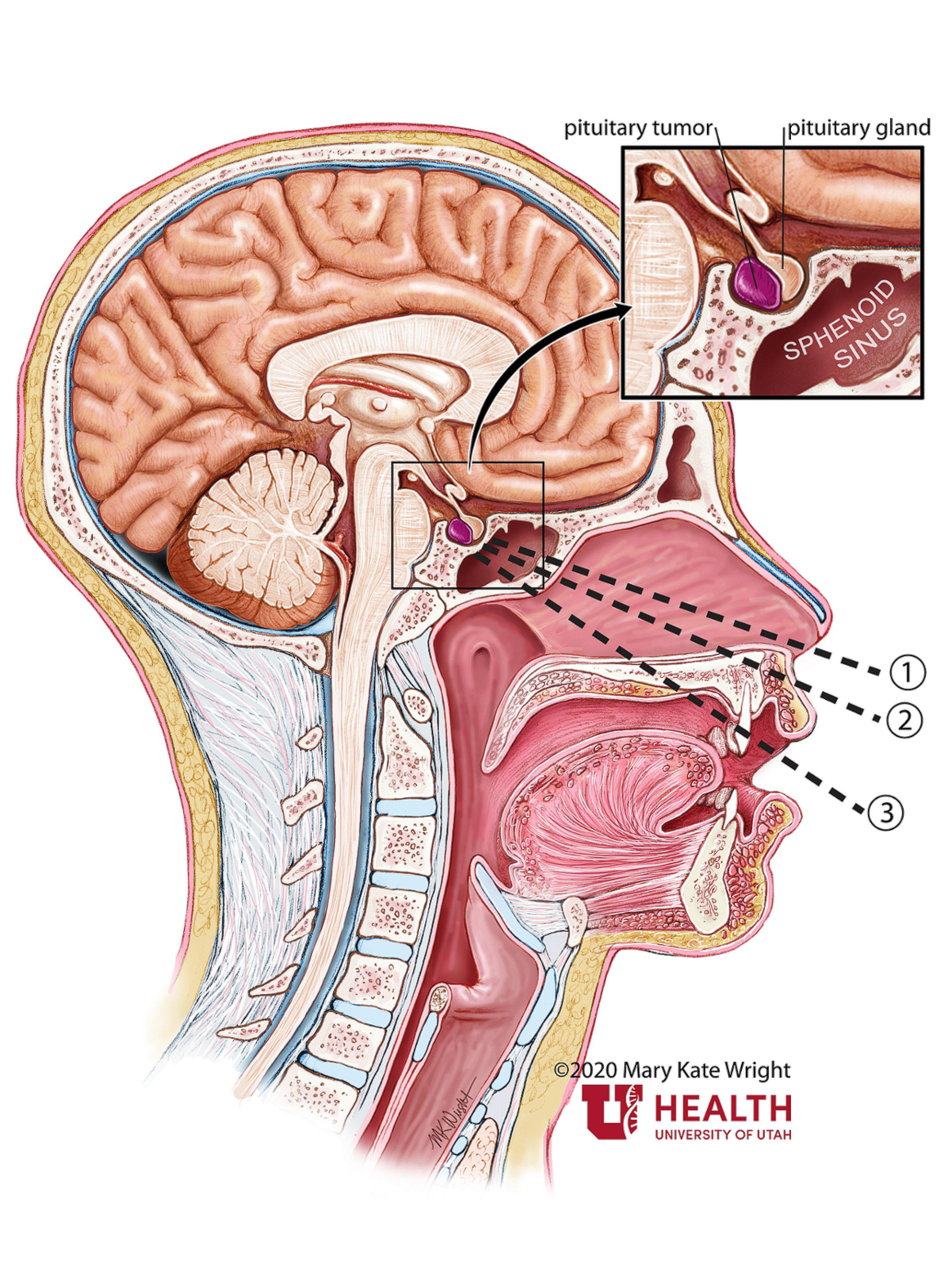 Pituitary tumor anatomy