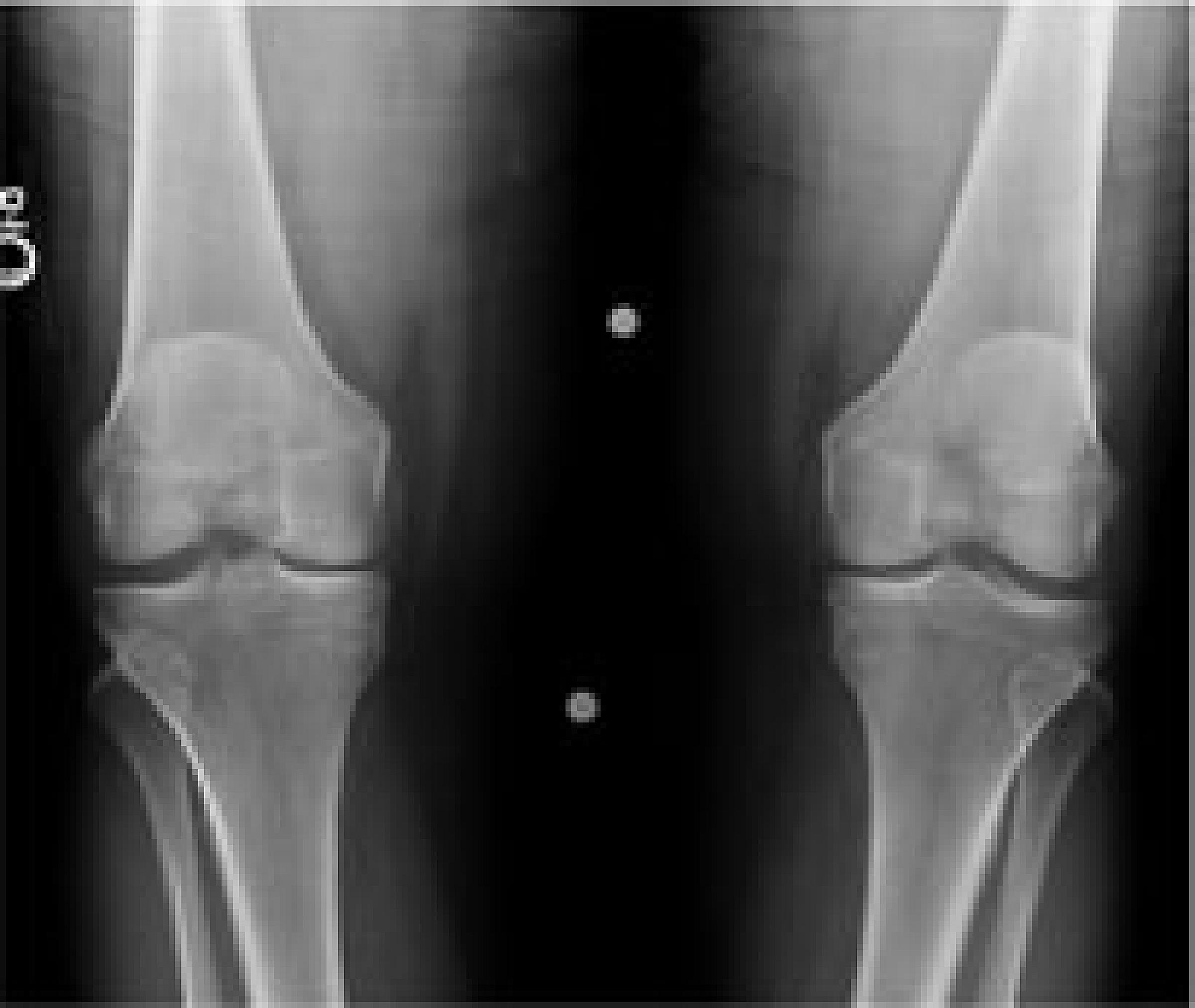 X-ray of knee bones before partial knee replacement surgery