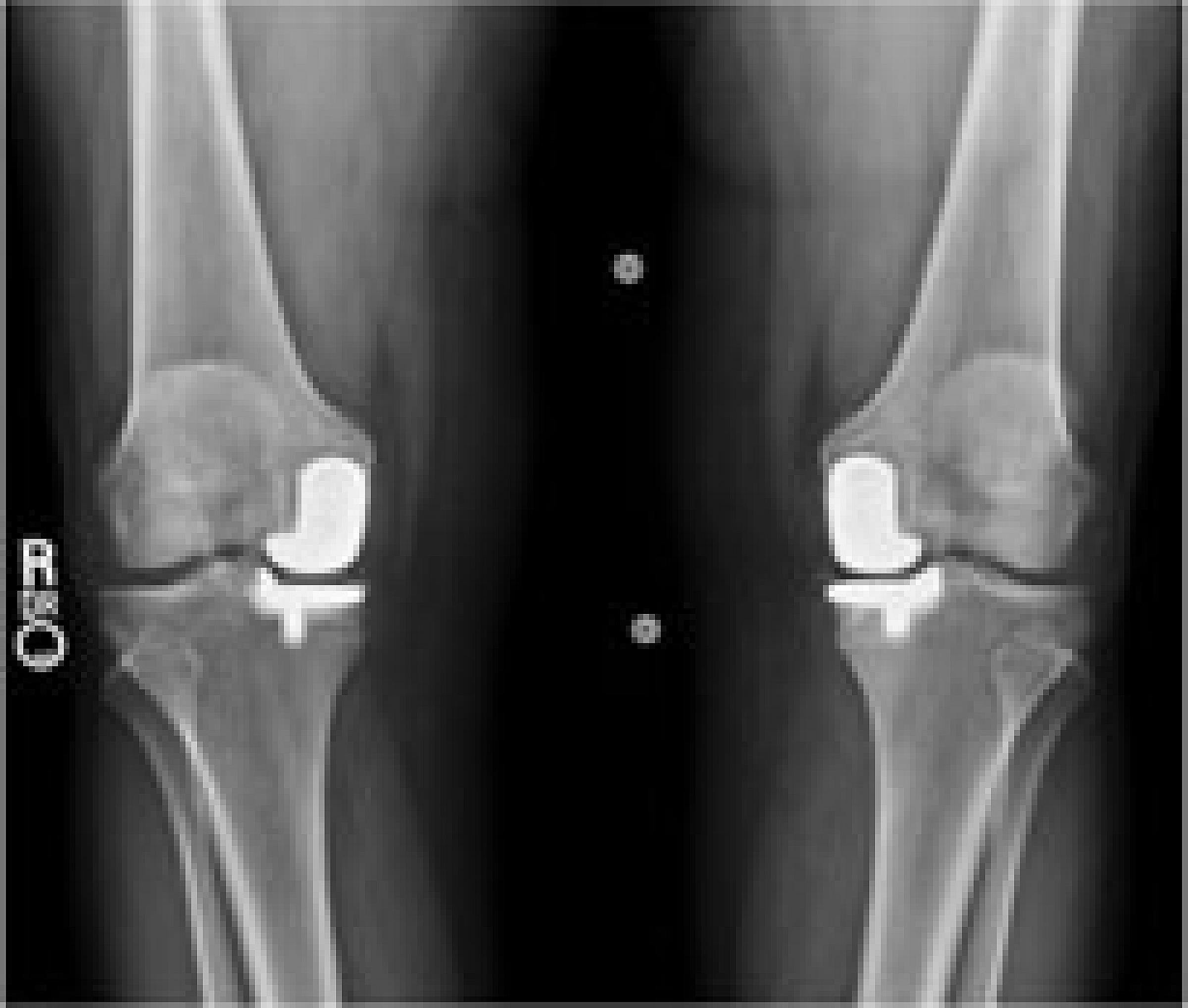 X-ray of knee bones after partial knee replacement