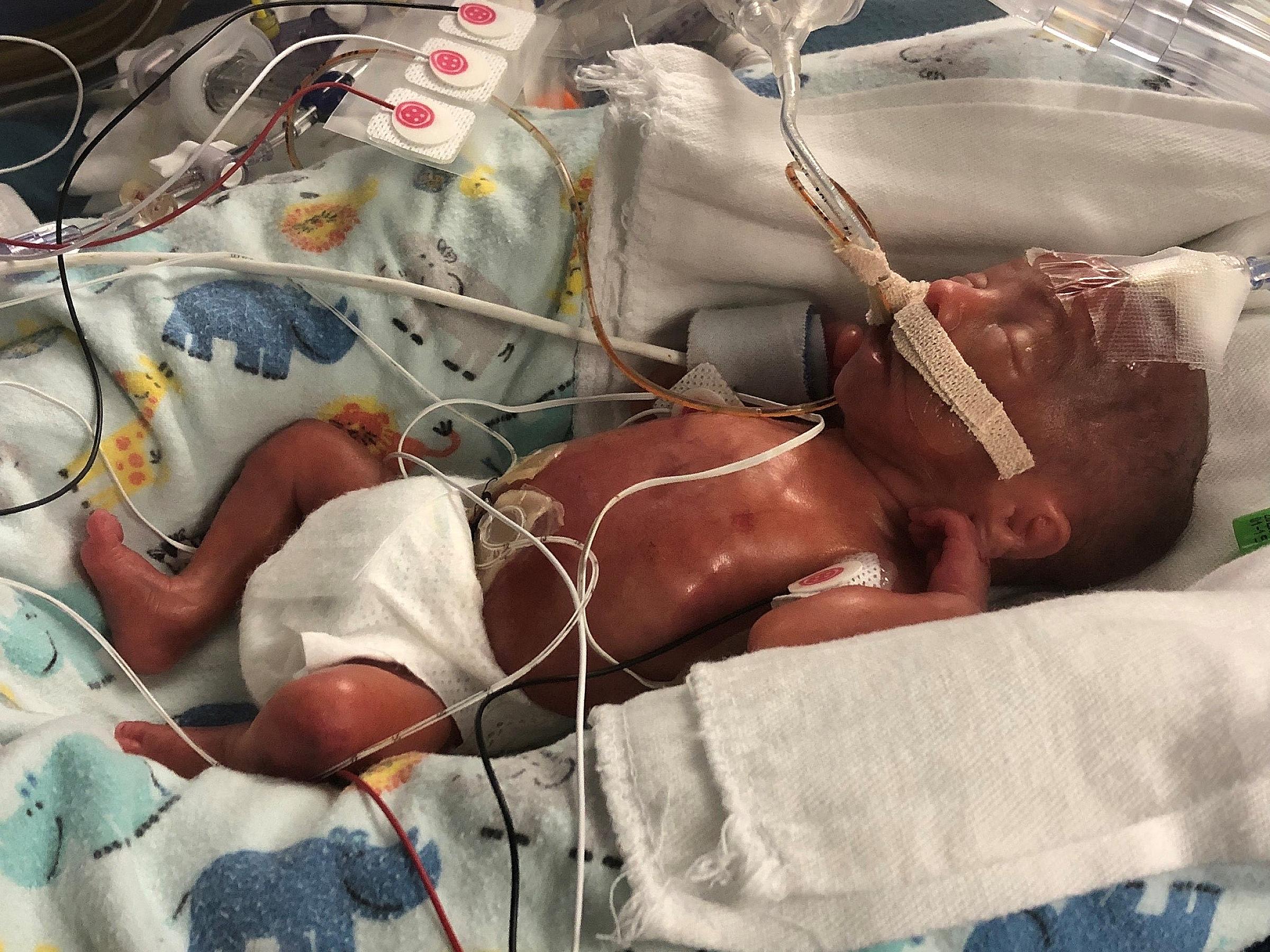 Avery Matney, NICU baby at University of Utah Health