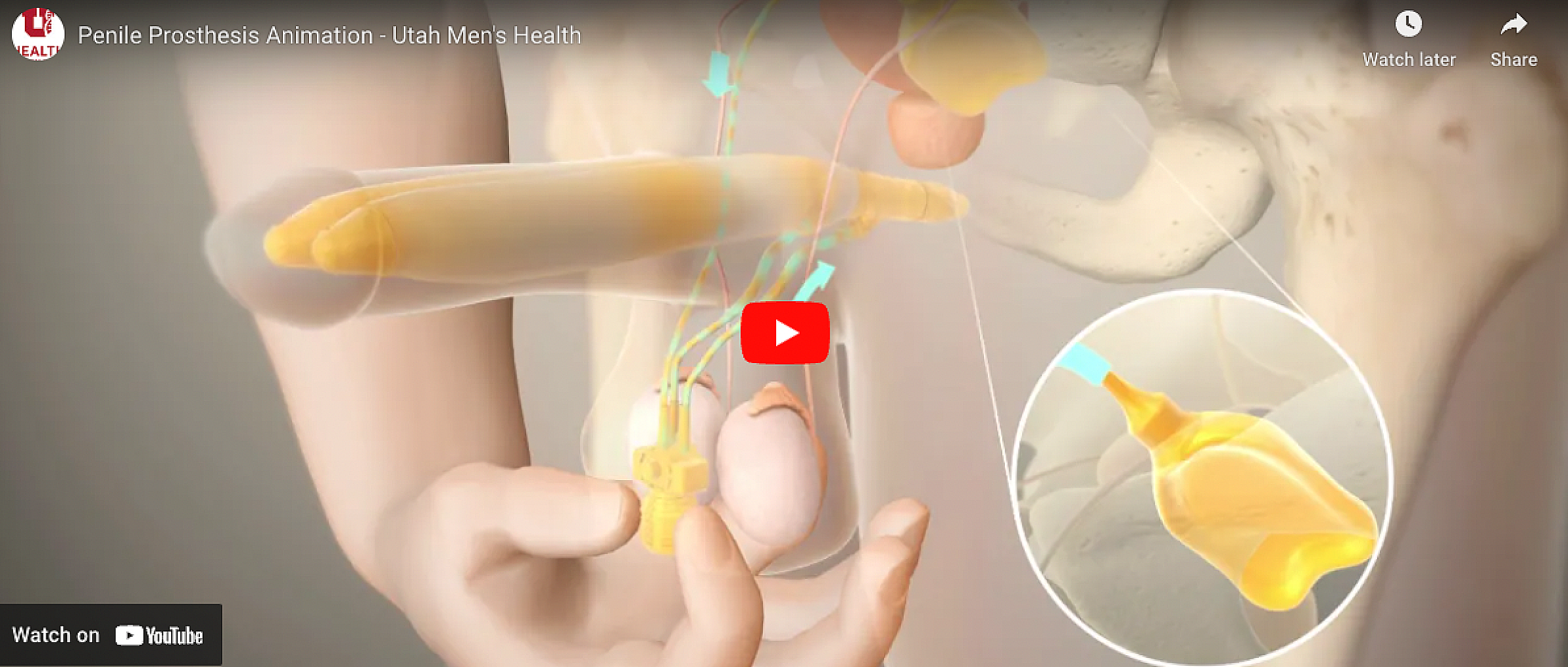 Thumbnail for Penile Prosthesis Animation Youtube Video