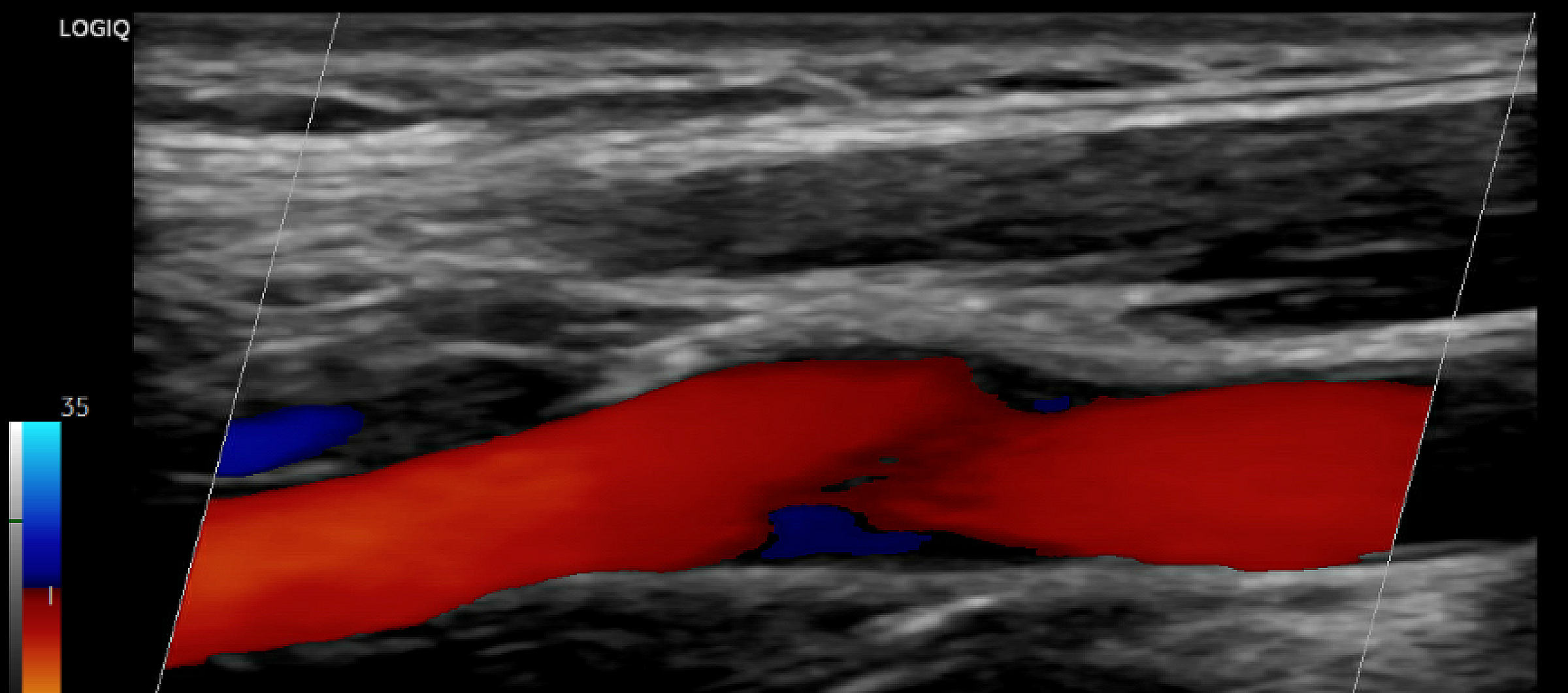 Vascular ultrasound of carotid artery. The artery is highlighted in orange.