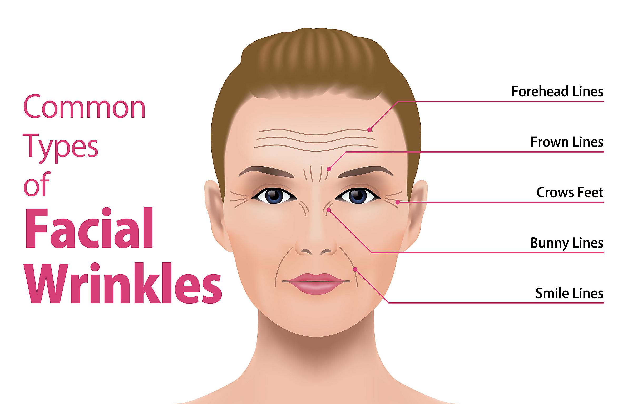 Facial wrinkles that are good options for Botox or other neuromodulators