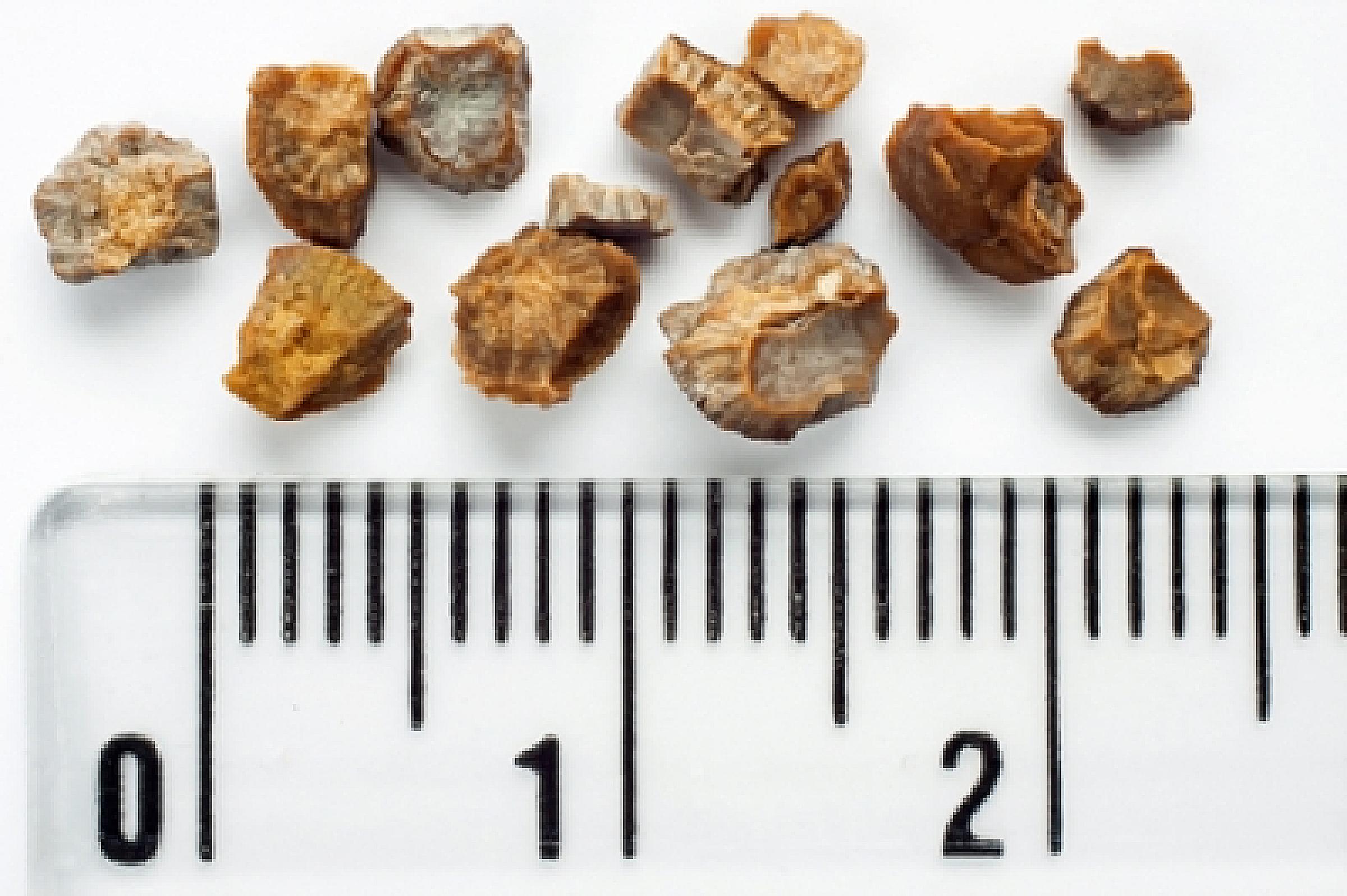 Kidney stones and ruler