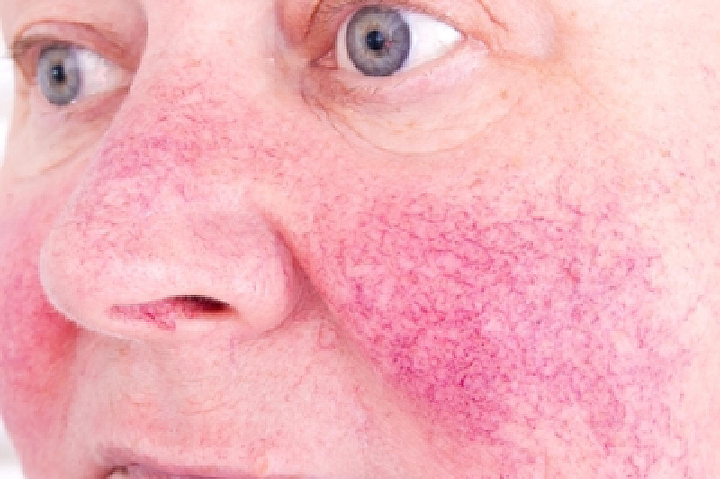 Man with rosacea