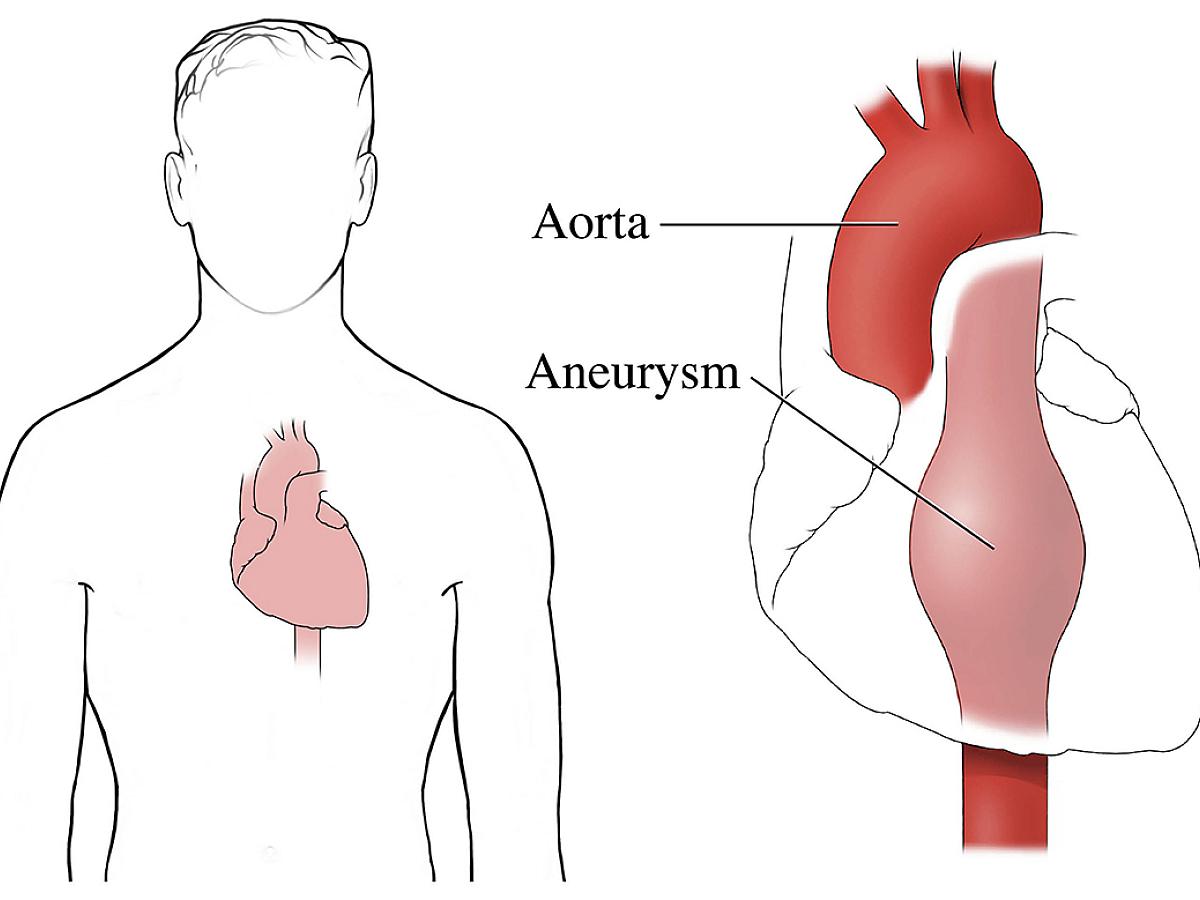 Anatomy illustration of an aortic aneurysm