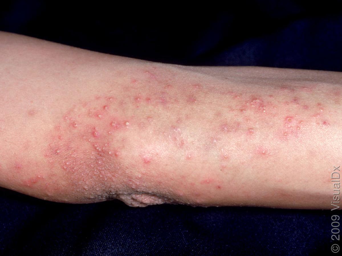 Arm with dermatitis herpetiformis