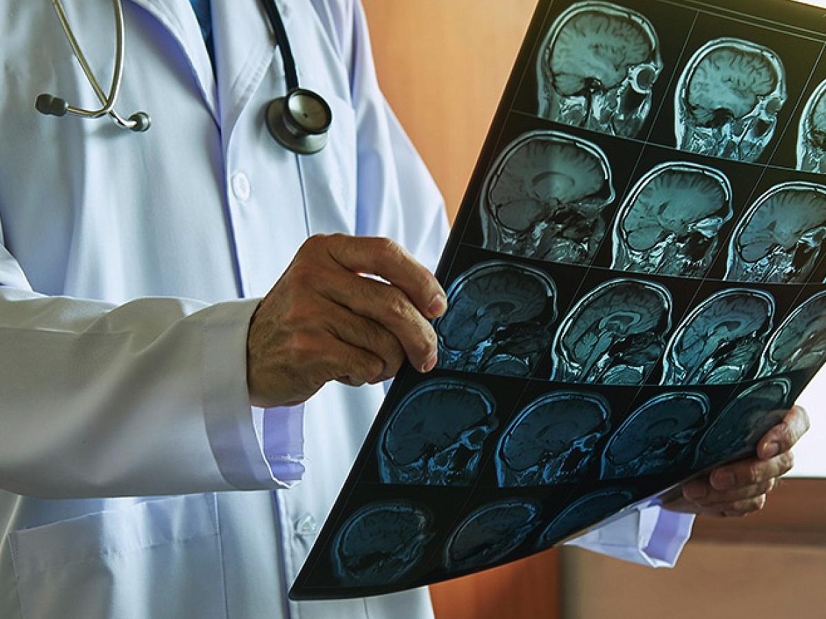 Doctor holds up brain scan results