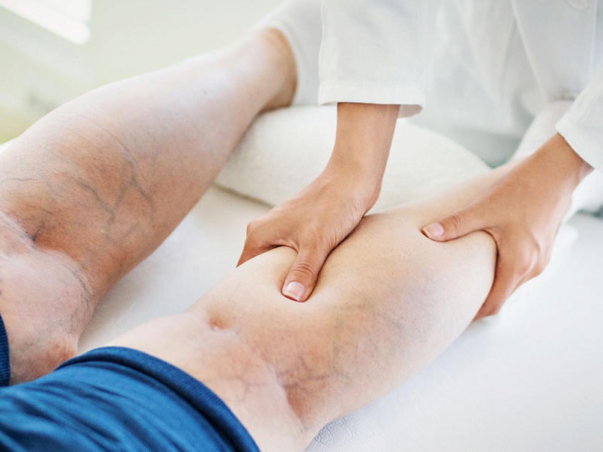 Picture of doctor examining varicose veins on a patient's leg
