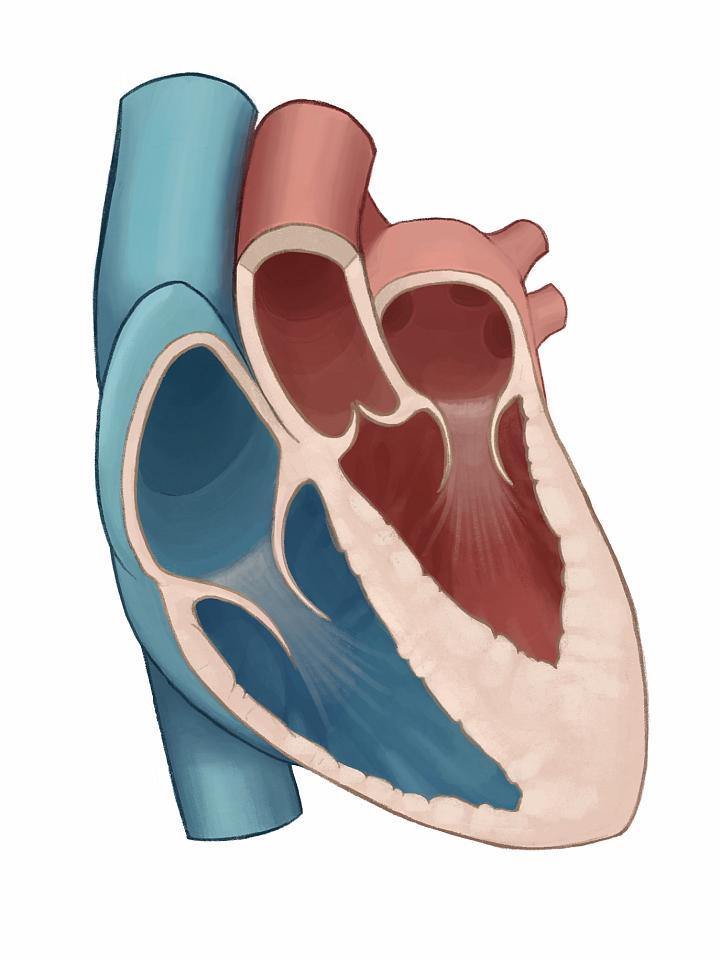 Illustration of apical hypertrophic cardiomyopathy | University of Utah Health