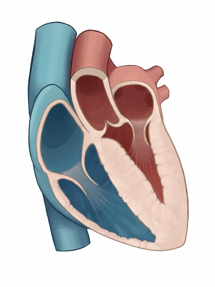 Illustration of diffuse hypertrophic cardiomyopathy | University of Utah Health