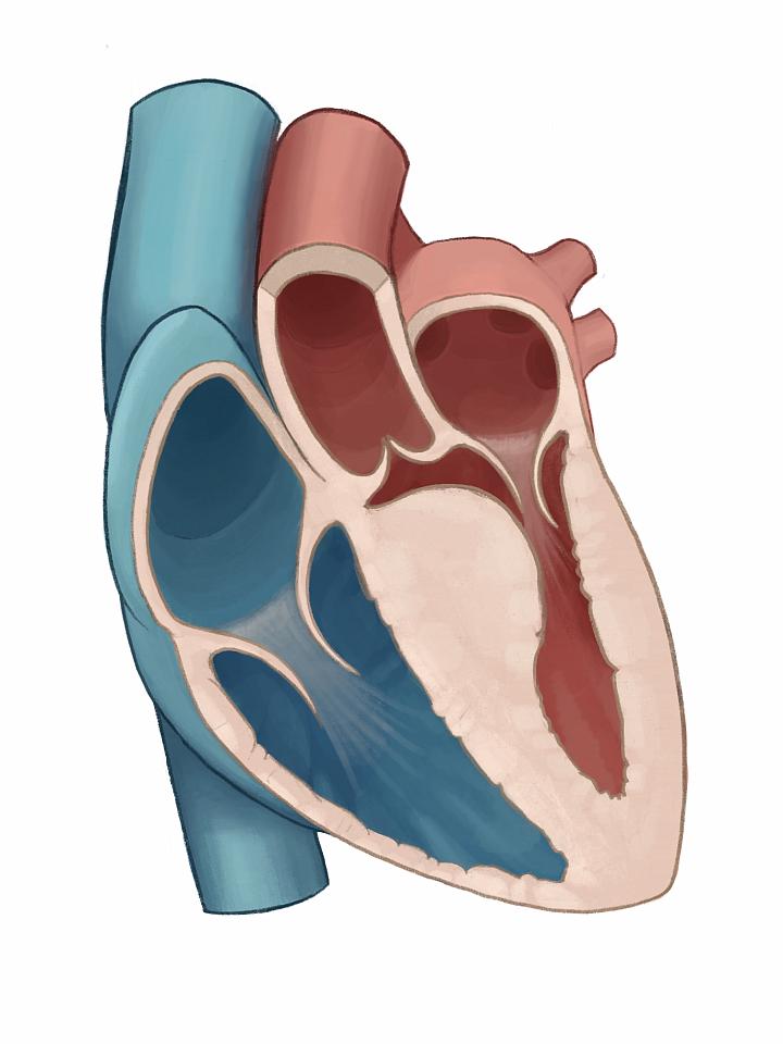 Illustration of obstructive hypertrophic cardiomyopathy | University of Utah Health