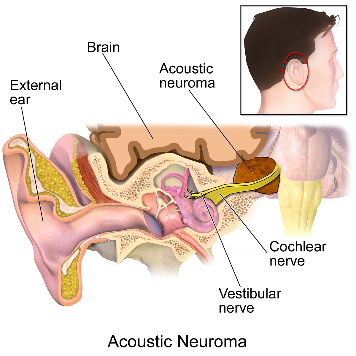 Acoustic neuroma anatomy