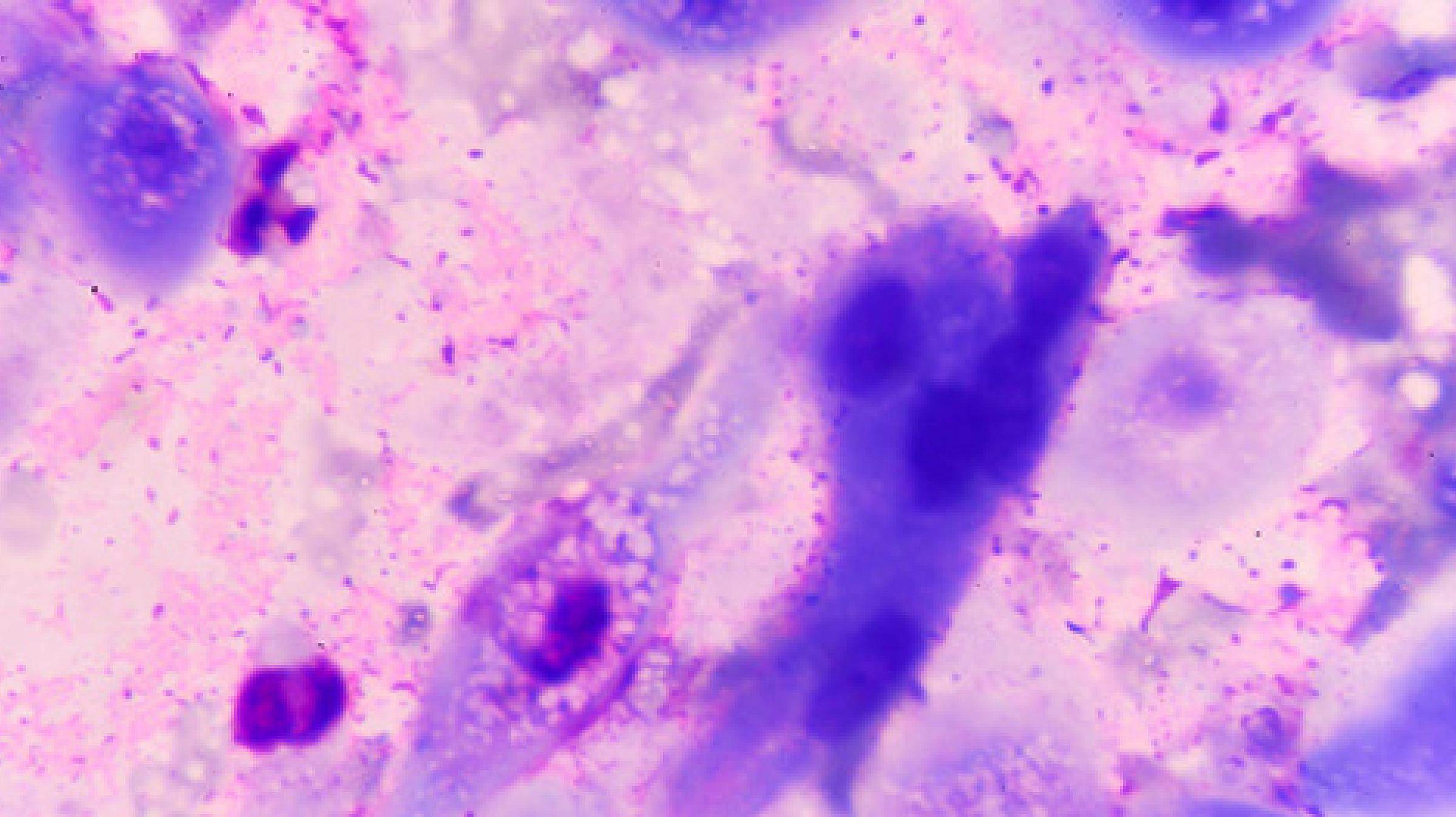 Amyloidosis protein